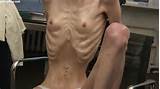 Free Porn Pics Of Dream Of Bones Sexy And Anorexic Skinny Janine 14