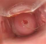 cervix with the string of iud showing 1023 215 979 img src